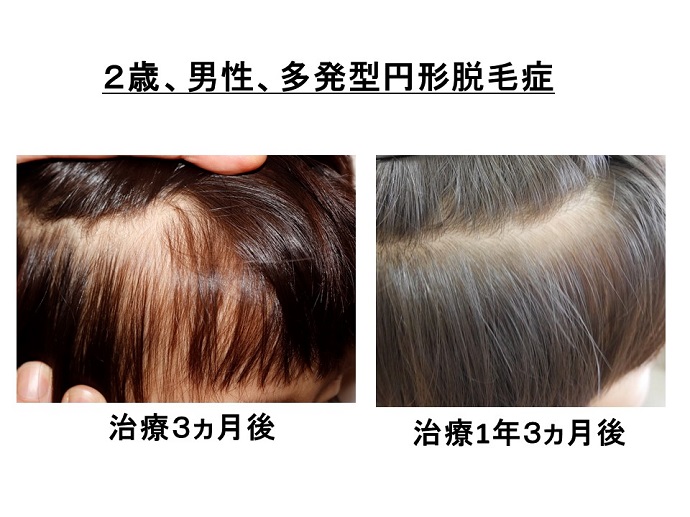 円形脱毛症　病院
